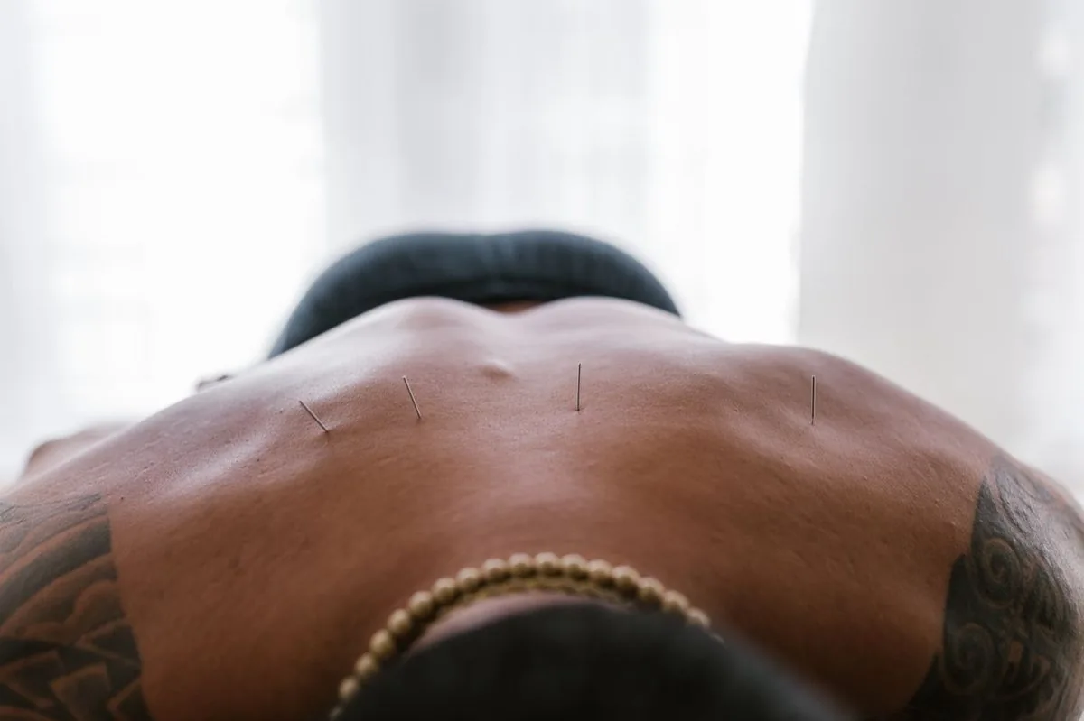 Fine acupuncture needles placed on a patient’s back; illustrative photograph