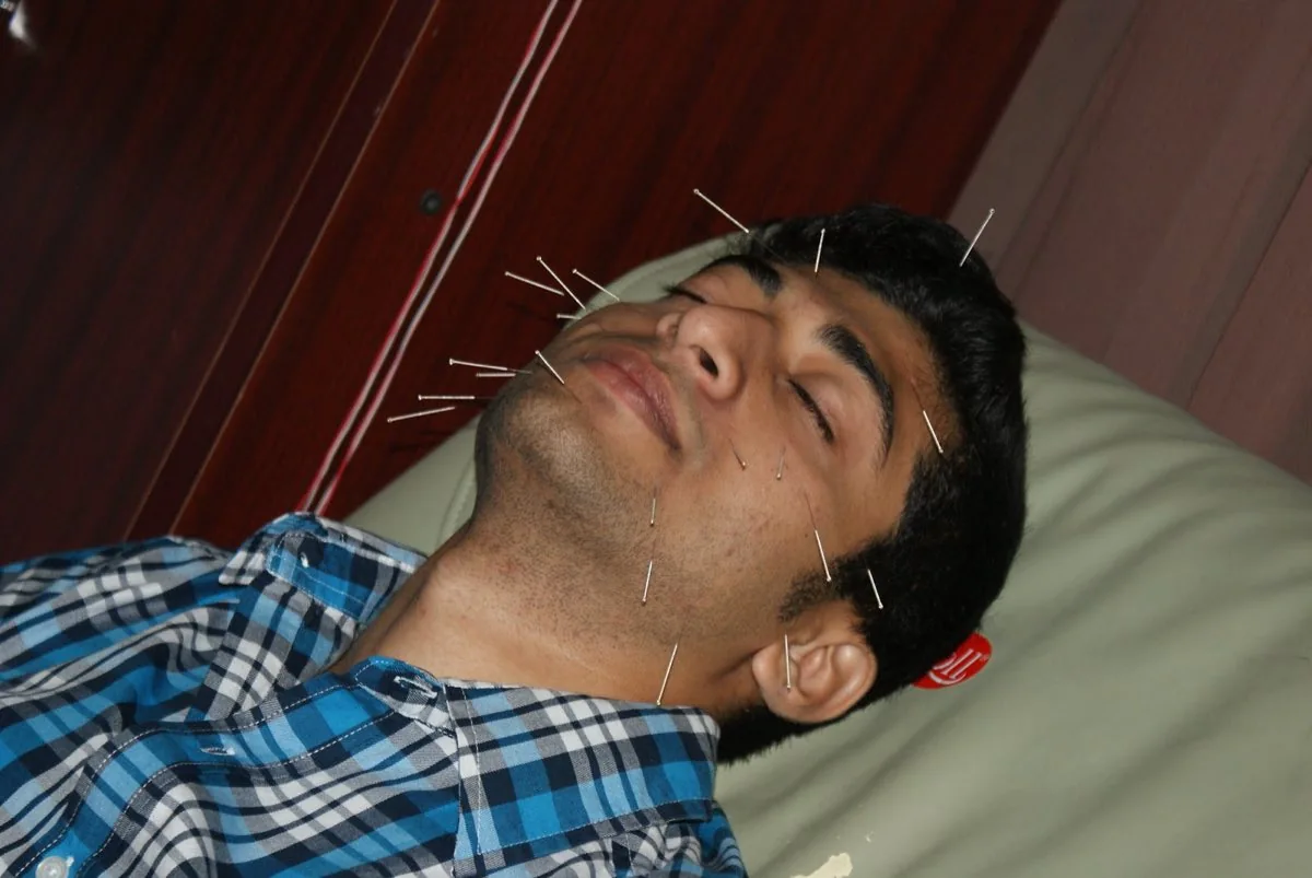 A patient resting with facial acupuncture needles; illustrative photograph