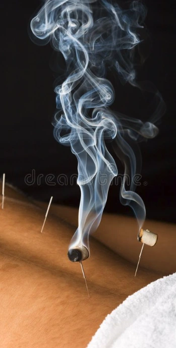 Moxa warming acupuncture needles; illustrative supplied image