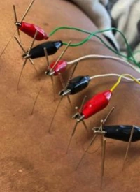 Electrical leads connected to acupuncture needles; illustrative supplied image
