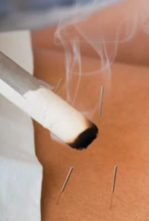 A moxa stick near acupuncture needles; illustrative supplied image