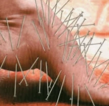 Acupuncture needles on a hand; illustrative supplied image