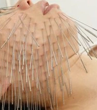 A close view of facial acupuncture needles; illustrative supplied image