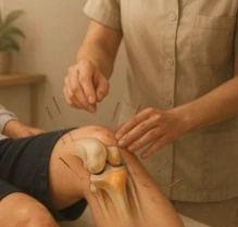 An illustration of acupuncture around an anatomical knee model