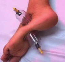 Cups applied near the ankle and foot; illustrative supplied image