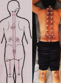 A supplied comparison of an acupuncture-point illustration and back cupping